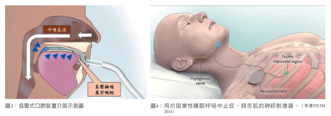 圖3：負壓式口腔裝置介面示意圖