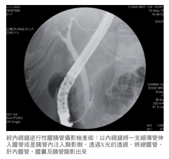 經內視鏡逆行性膽胰管攝影檢查術