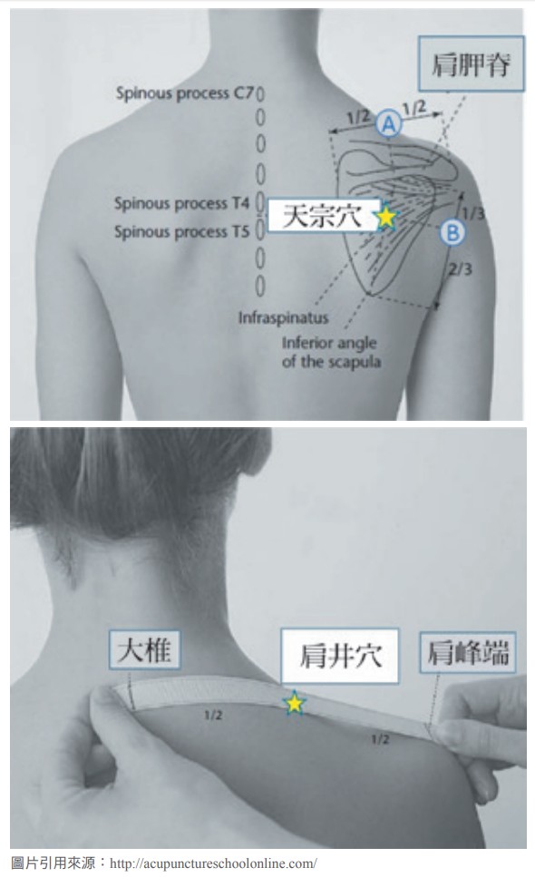  肩背穴位（可搭配拔罐）