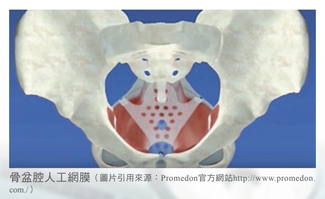 骨盆腔人工網膜