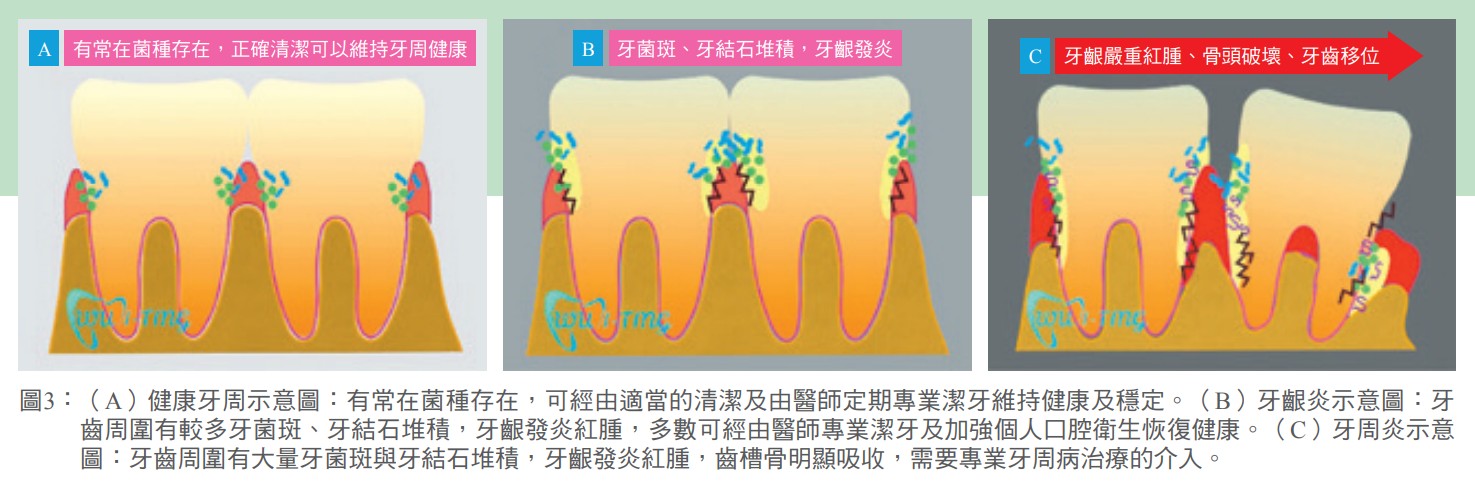 圖3：（A）健康牙周示意圖：有常在菌種存在，可經由適當的清潔及由醫師定期專業潔牙維持健康及穩定。