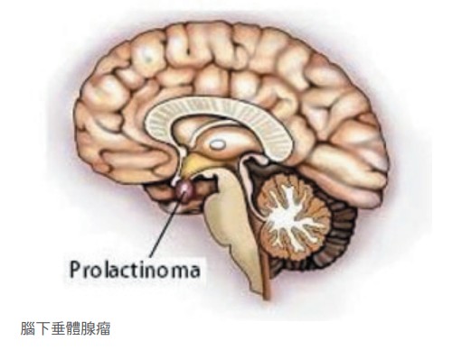 腦下垂體腺瘤 