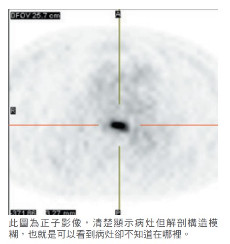 此圖為正子影像