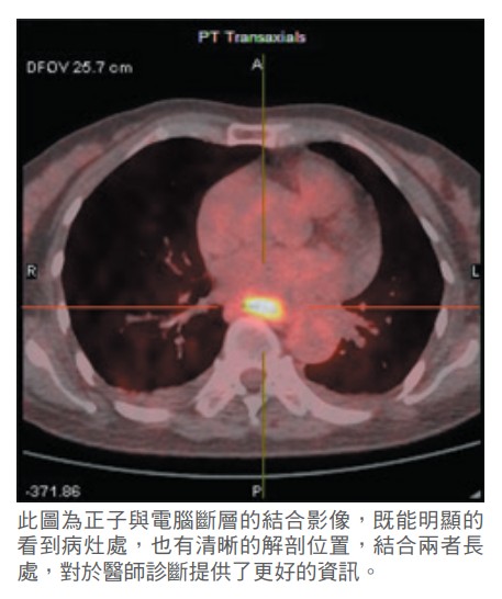 此圖為正子與電腦斷層的結合影像