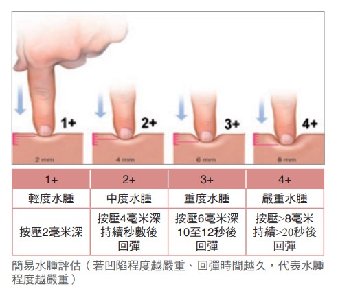 簡易水腫評估