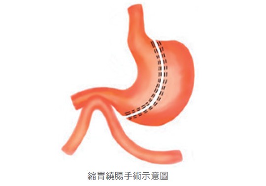 縮胃繞腸手術示意圖