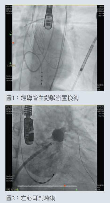 圖1：經導管主動脈辦置換術