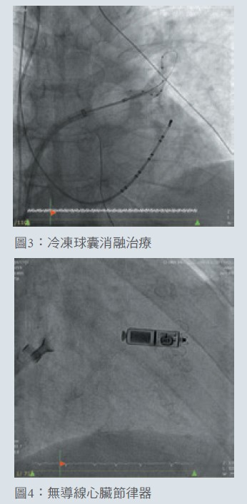 圖3：冷凍球囊消融治療