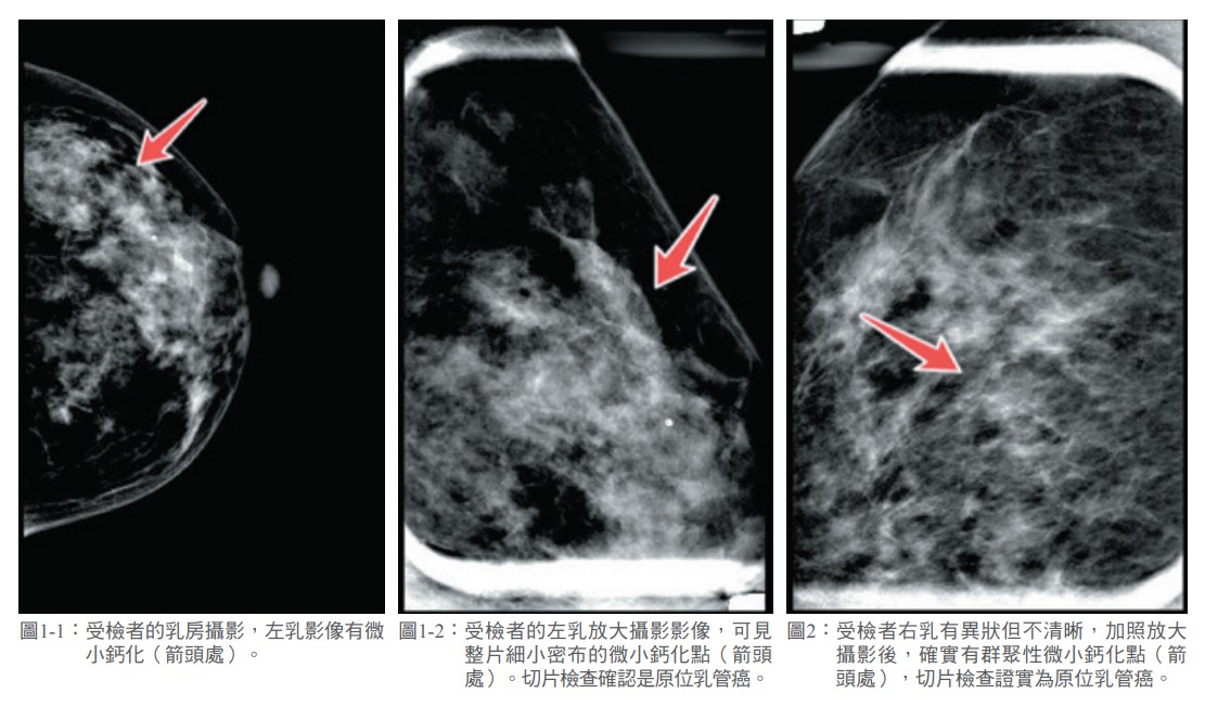 圖1-1： 受檢者的乳房攝影，左乳影像有微 小鈣化（箭頭處）。