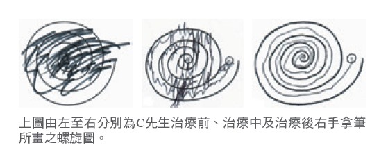 上圖由左至右分別為C先生治療前、治療中及治療後右手拿筆所畫之螺旋圖。