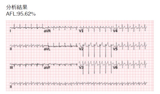 人工智慧心電圖判讀心房撲動心律不整