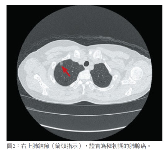 圖2：右上肺結節（箭頭指示），證實為極初期的肺腺癌。