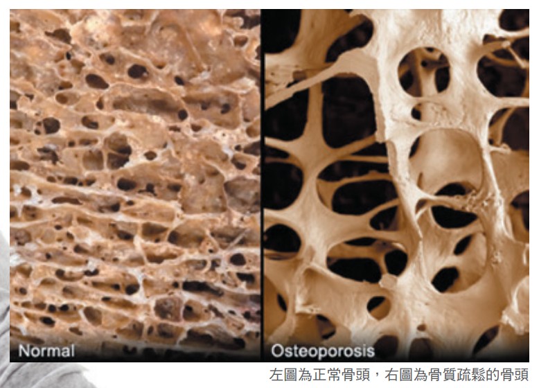 左圖為正常骨頭，右圖為骨質疏鬆的骨頭