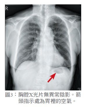 圖3： 胸腔X光片無異常陰影。箭頭指示處為胃裡的空氣。