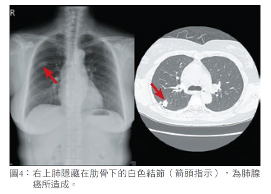 圖4： 右上肺隱藏在肋骨下的白色結節（箭頭指示），為肺腺癌所造成。