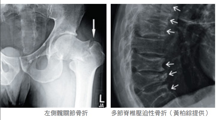 左側髖關節骨折 多節脊椎壓迫性骨折（黃柏綜提供）