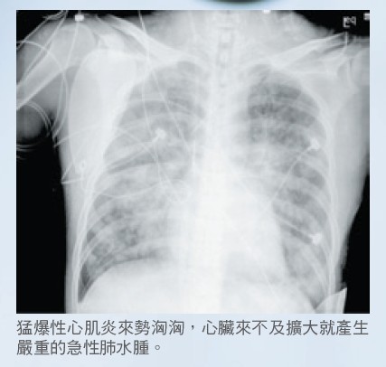 猛爆性心肌炎來勢洶洶，心臟來不及擴大就產生嚴重的急性肺水腫。