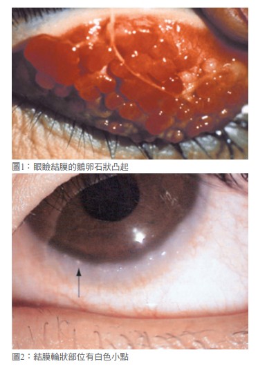 圖1：眼瞼結膜的鵝卵石狀凸起