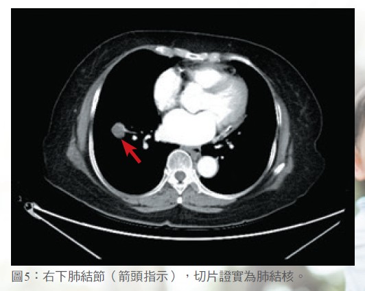 圖5：右下肺結節（箭頭指示），切片證實為肺結核。