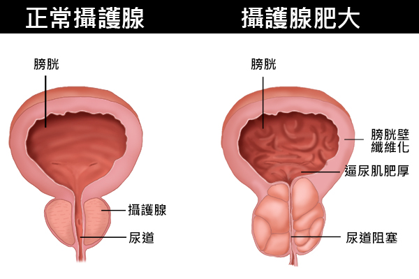 攝護腺肥大 