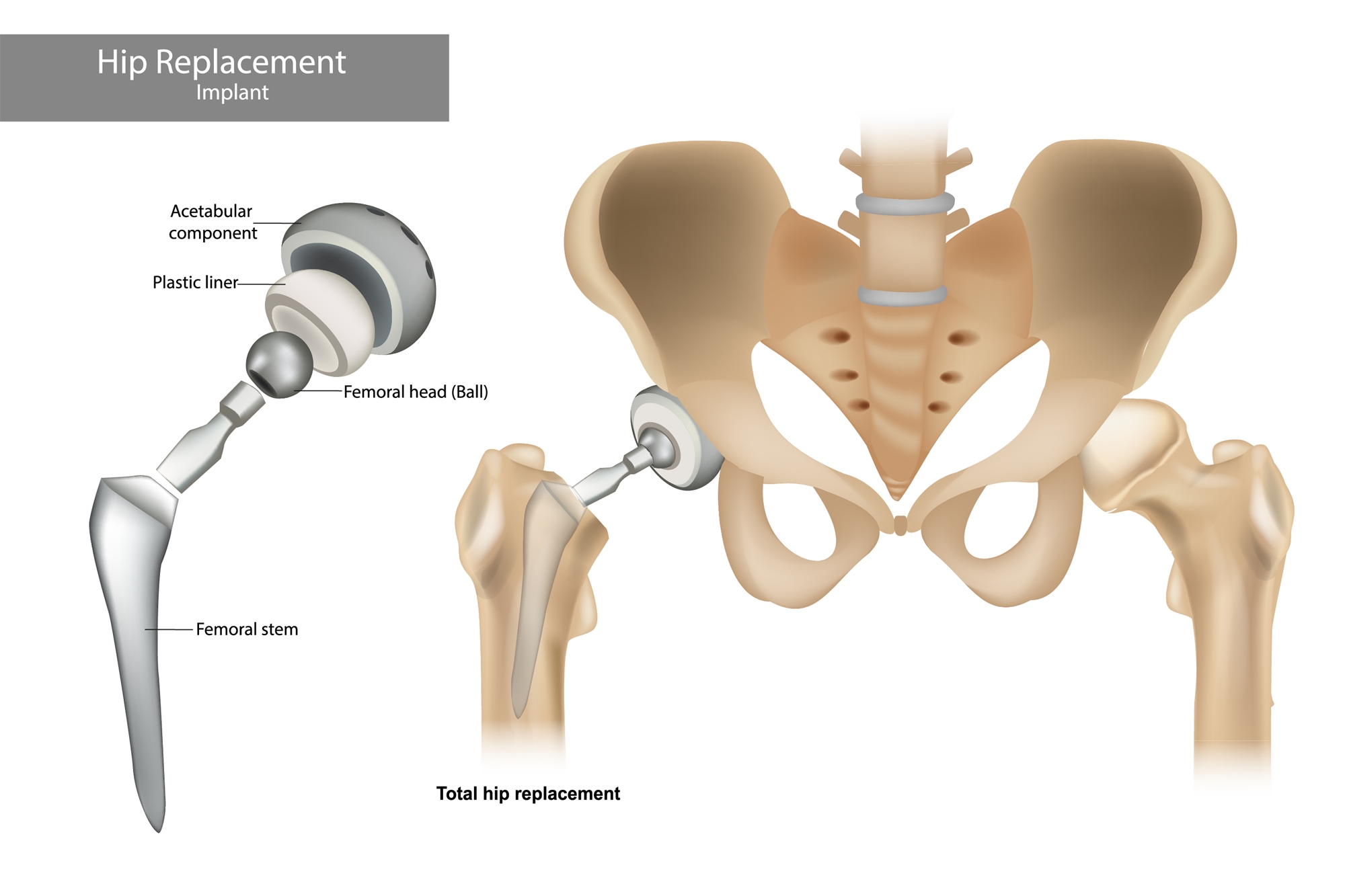 人工股関節置換術 人工股関節置換術（Total Hip Arthroplasty, THA） | おゆみの