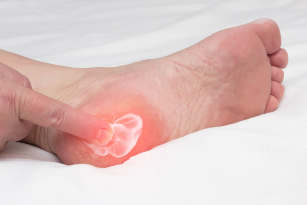 Plantar Fasciitis China Medical University