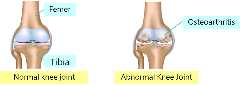 Total Knee Replacement Guidebook 人工膝關節置換術衛教手冊