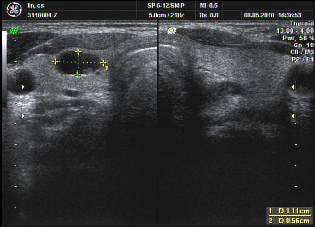 甲狀腺超音波檢查及細針穿刺細胞學檢查