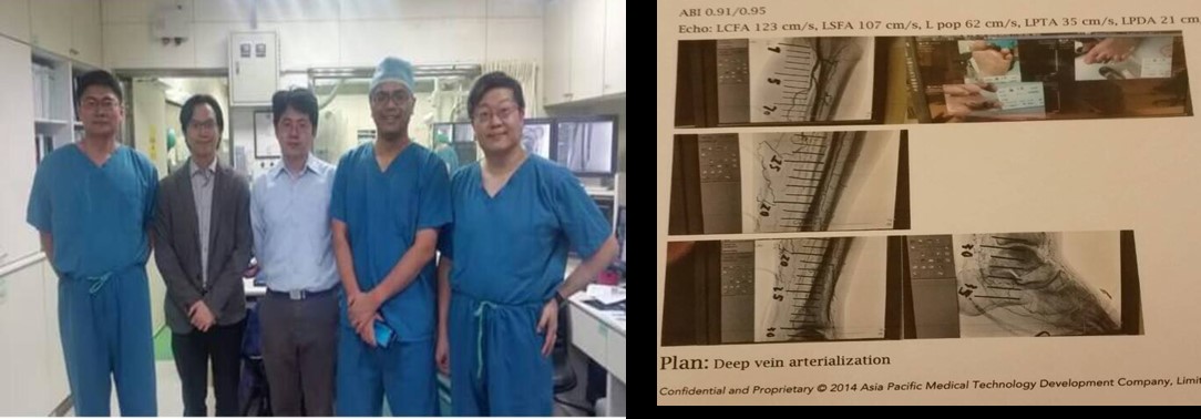 完成東亞、台灣第一例，全球第八例 Deep vein arterialization。