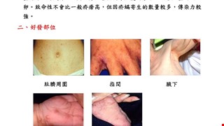 認識疥瘡