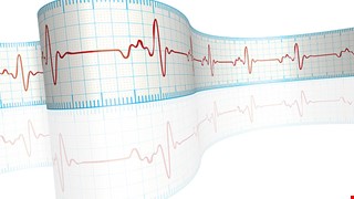 Catheter ablation 心臟電燒術