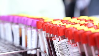 Hyperlipidemia 認識高脂血症