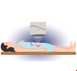 A new option for the treatment of uterine fibroids- HIFU Ablation Therapy 子宮肌瘤治療新選擇-海芙消融治療術(HIFU)