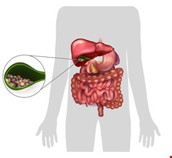 Gallstones 膽結石