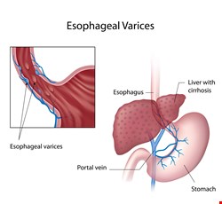 Esophageal Varices and Bleeding 食道靜脈曲張及出血
