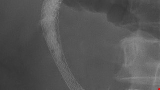 Instructions for Gastrointestinal Metallic Stenting Post-Surgical Health Education 腸胃道金屬支架術後衛教說明