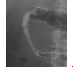 Instructions for Gastrointestinal Metallic Stenting Post-Surgical Health Education 腸胃道金屬支架術後衛教說明