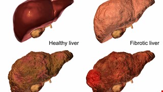 Understanding Liver Cancer 了解肝癌
