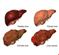 Understanding Liver Cancer 了解肝癌