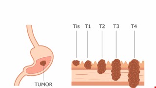 Early Symptoms of Stomach Cancer 胃癌的早期症狀