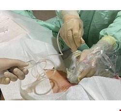 Liver Biopsy 肝切片檢查