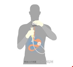 內視鏡胃造口術後之居家護理