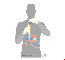 Home Care After Endoscopic Gastrostomy 內視鏡胃造口術後之居家護理