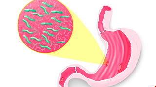 胃幽門螺旋桿菌診斷及治療