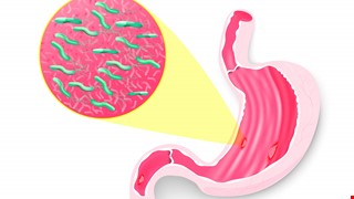 Therapy and Diagnosis for Helicobacter Pylori 胃幽門螺旋桿菌診斷及治療