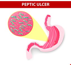 Therapy and Diagnosis for Helicobacter Pylori 胃幽門螺旋桿菌診斷及治療