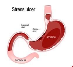 Peptic Ulcer & Bleeding 消化性潰瘍及出血