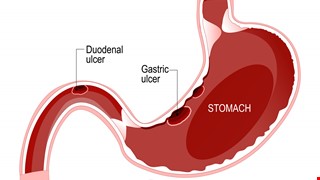 Peptic Ulcer & Bleeding 消化性潰瘍及出血