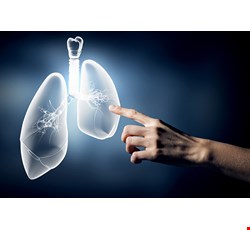 Post-Operative Health Education and Instructions for Tracheobronchial Stents Placement 氣管支氣管支架放置術後衛教說明