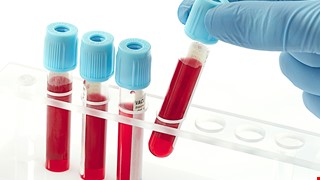 Arterial blood gas analysis 動脈血液氣體分析